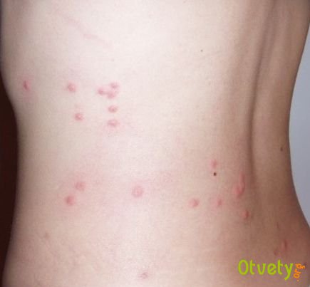 Как избавиться от укусов блох. Методы борьбы с блохами и профилактика их появления в помещении. Как избавиться от укусов блох. Методы борьбы с блохами и профилактика их появления в помещении.